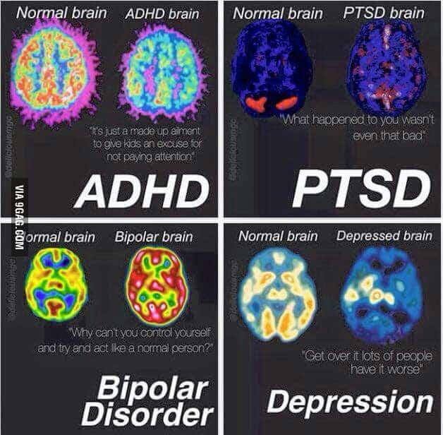 ADHD, PTSD, Bipolar Disorder, and Depression brains vs disorder free ...