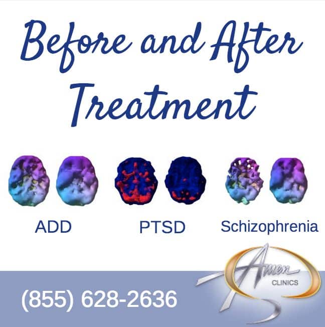 Before &  After Treatment at Amen Clinics. #PTSD, #ADD, #Schizophrenia ...