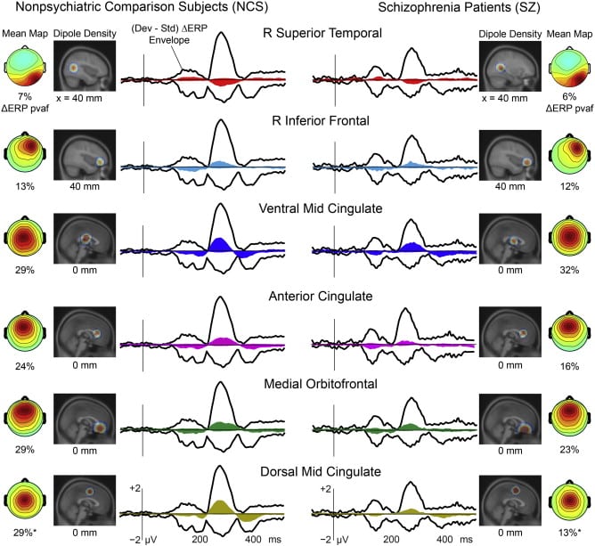EEG Tests May Help Retrain Schizophrenia Patientsâ Auditory Brain ...