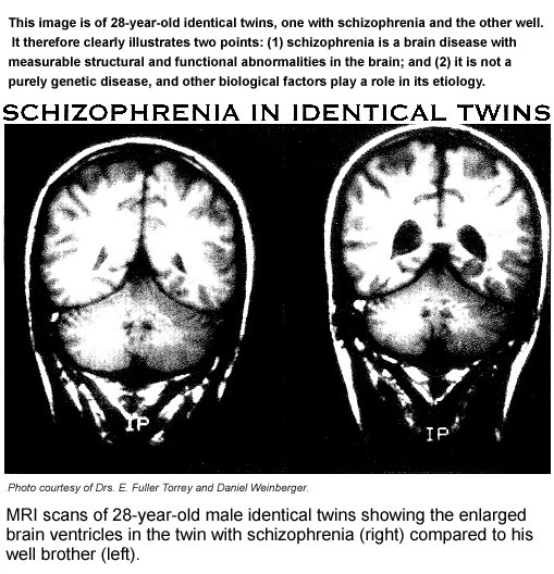 Schizophrenia in Identical Twins