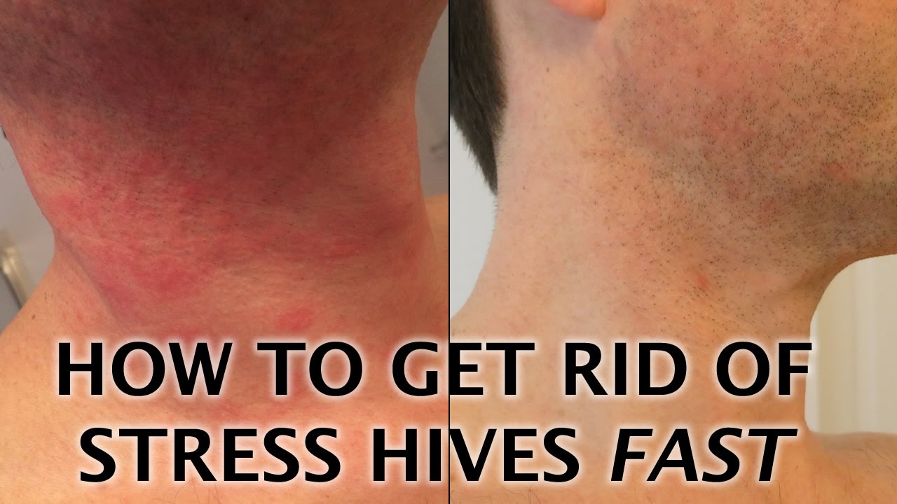 Stress Hives Treatment
