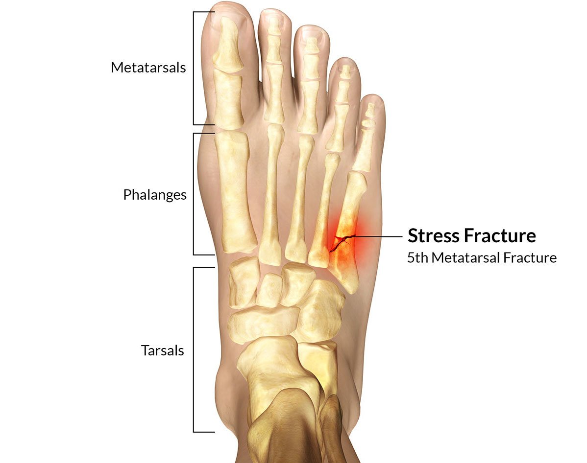 What Does A Stress Fracture Feel Like? How Do You Treat It?
